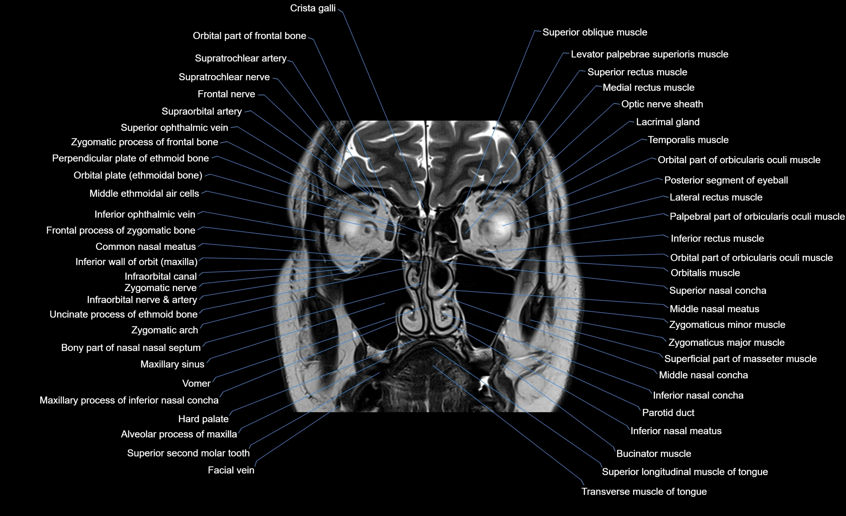 MRI face & paranasal sinuses(PNS) labelled  coronal  cross sectional anatomy 3T radiology  image-img-00001-00021.webp